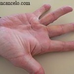dupuytren_1