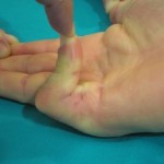 dupuytren_3