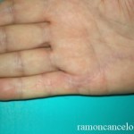 dupuytren_5