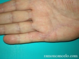 dupuytren_5
