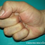 dupuytren_6