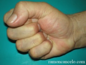 dupuytren_6